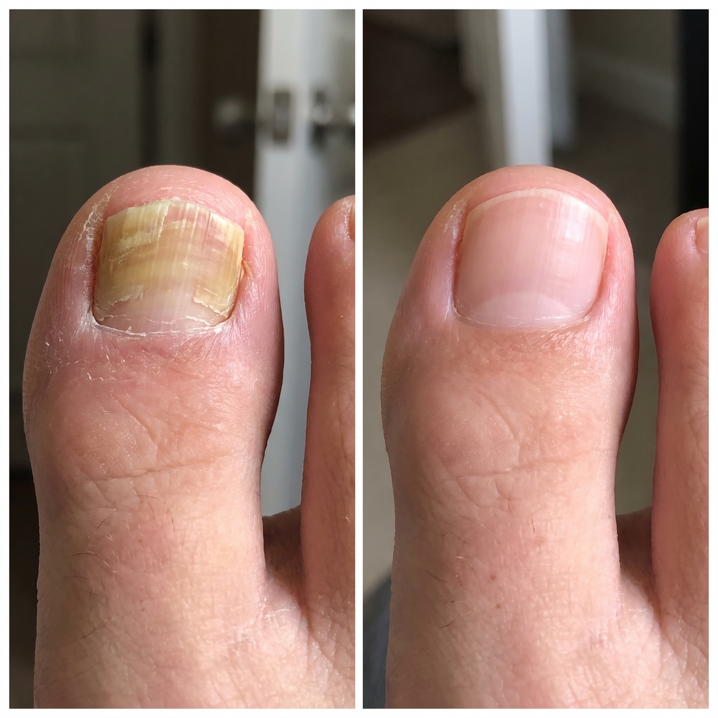 DermaLux Fungico® | Elimina el Hongo de la Uña en 7 días